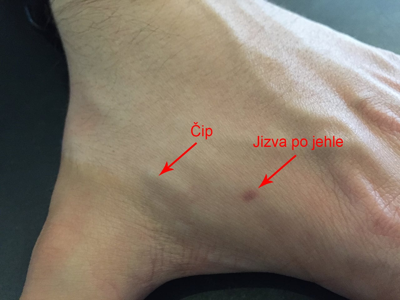 Jizva postupně vybledne a čipy skoro není vidět.